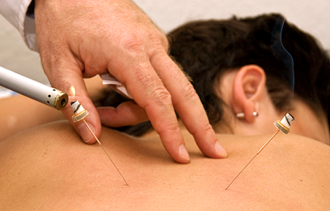 Akupunktur